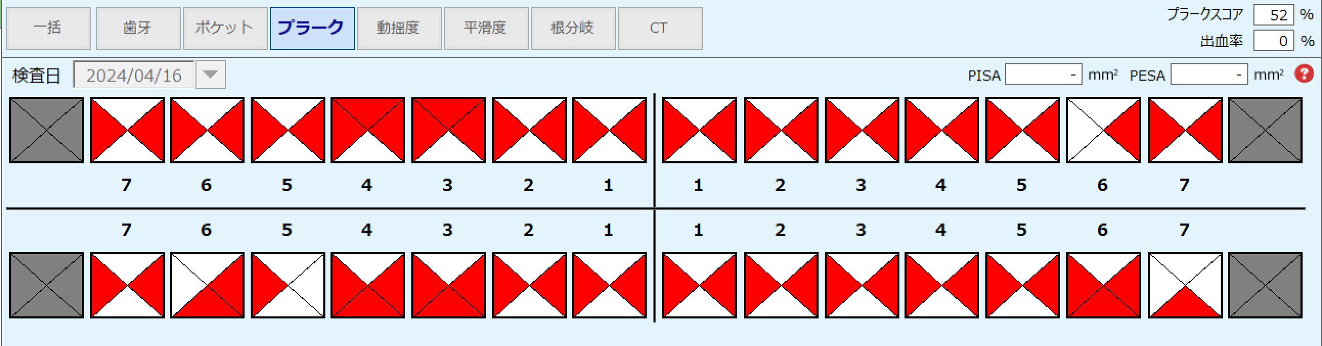 PCR表(1つの歯を4ブロックに分けて磨き残しを記録した表)