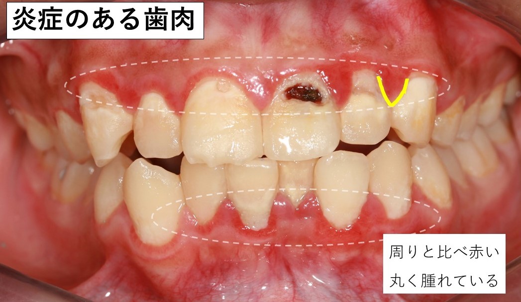 歯肉炎になって腫れている歯肉