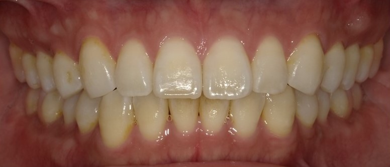 念入りに歯みがきをした後の歯の写真(染め出し前)