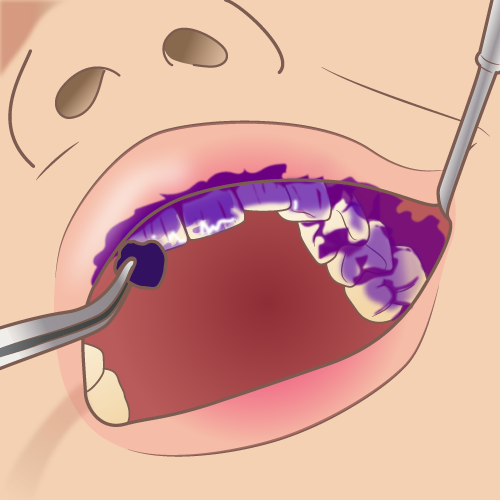 歯垢の染め出し液のイラスト