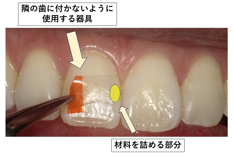コンポジットレジン充填の際に歯と歯の間に使う器具