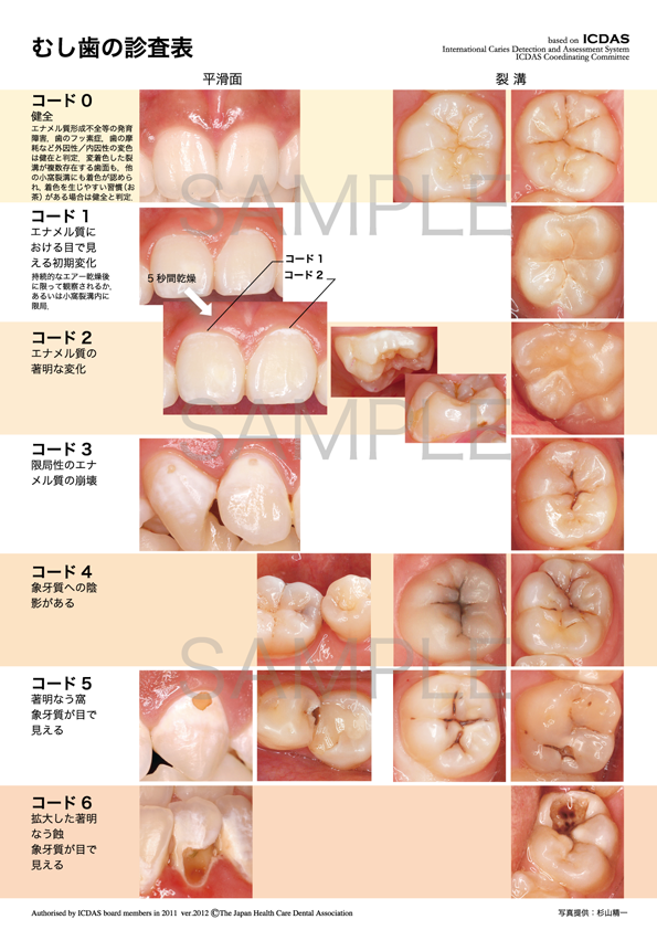 むし歯の分類 ICDAS(コード0〜6)