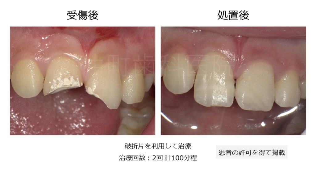 歯の破折 術後