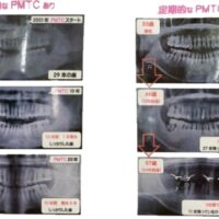 定期的なPMTCの有無