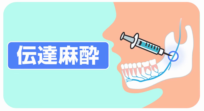 伝達麻酔のイラスト