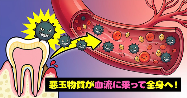 悪玉物質が血流に乗って全身へと流れるイラスト