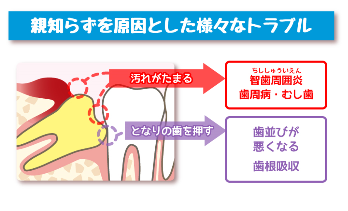 親知らずの基礎知識 周智郡森町 仲町歯科医院