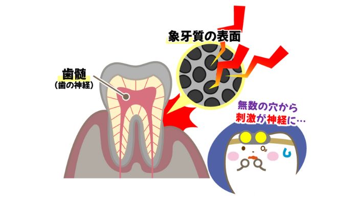 歯の象牙質への刺激